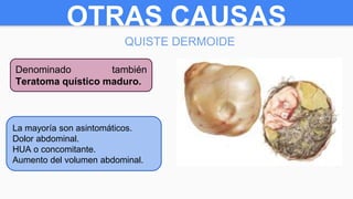 OTRAS CAUSAS
QUISTE DERMOIDE
Denominado también
Teratoma quístico maduro. ➔ Tumor benigno que se
presenta en mujeres jóvenes
(20-40 años).
➔ Se originan a partir de
células embrionarias
pluripotenciales.
La mayoría son asintomáticos.
Dolor abdominal.
HUA o concomitante.
Aumento del volumen abdominal.
 