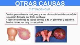 OTRAS CAUSAS
CISTOADENOMA
Quistes generalmente benignos que se deriva del epitelio superficial
(celómico), formado por áreas quísticas.
A veces están llenos de líquido acuoso o de un gel denso y pegajoso.
Pueden crecer mucho y producir dolor.
 