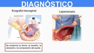 DIAGNÓSTICO
Ecografia trasvaginal. Laparoscopia.
Se evidencia la forma, el tamaño, la
ubicación y la composición del quiste.
 