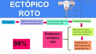 ECTÓPICO
ROTO
 