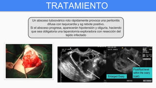 TRATAMIENTO
Un absceso tuboovárico roto rápidamente provoca una peritonitis
difusa con taquicardia y sg rebote positivo.
Si el absceso progresa, aparecerán hipotensión y oliguria, haciendo
que sea obligatoria una laparotomía exploradora con resección del
tejido infectado
 
