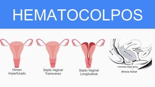 HEMATOCOLPOS
 