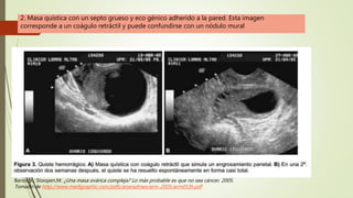 2. Masa quística con un septo grueso y eco génico adherido a la pared. Esta imagen
corresponde a un coágulo retráctil y puede confundirse con un nódulo mural
Barois,V.; Stoopen,M. ¿Una masa ovárica compleja? Lo más probable es que no sea cáncer. 2005.
Tomado de http://www.medigraphic.com/pdfs/anaradmex/arm-2005/arm053h.pdf
 