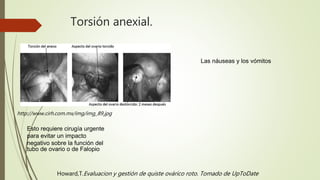 Torsión anexial.
http://www.cirh.com.mx/img/img_89.jpg
Esto requiere cirugía urgente
para evitar un impacto
negativo sobre la función del
tubo de ovario o de Falopio
Las náuseas y los vómitos
Howard,T.Evaluacion y gestión de quiste ovárico roto. Tomado de UpToDate
 