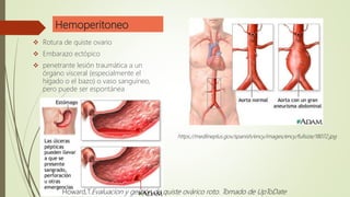 Hemoperitoneo
 Rotura de quiste ovario
 Embarazo ectópico
 penetrante lesión traumática a un
órgano visceral (especialmente el
hígado o el bazo) o vaso sanguíneo,
pero puede ser espontánea
https://medlineplus.gov/spanish/ency/images/ency/fullsize/18072.jpg
Howard,T.Evaluacion y gestión de quiste ovárico roto. Tomado de UpToDate
 