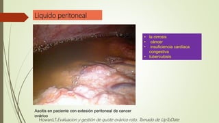 Liquido peritoneal
Ascitis en paciente con extesión peritoneal de cancer
ovárico
• la cirrosis
• cáncer
• insuficiencia cardíaca
congestiva
• tuberculosis
Howard,T.Evaluacion y gestión de quiste ovárico roto. Tomado de UpToDate
 