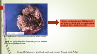 http://www.sego.es/Content/imgs/imgsctfcas/img_large/h1f186.jpg
Liberación de líquido del quiste o sangre que pueden
irritar la cavidad peritoneal.
irritación peritoneal grave. El tratamiento
quirúrgico por lo general se requiere para
la ruptura de un quiste dermoidé.
Howard,T.Evaluacion y gestión de quiste ovárico roto. Tomado de UpToDate
 