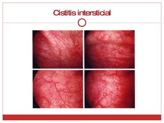 Cistitis intersticial 