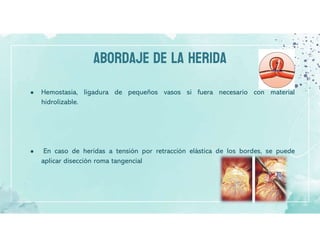 ABORDAJE DE LA HERIDA
● Hemostasia, ligadura de pequeños vasos si fuera necesario con material
hidrolizable.
● En caso de heridas a tensión por retracción elástica de los bordes, se puede
aplicar disección roma tangencial
 