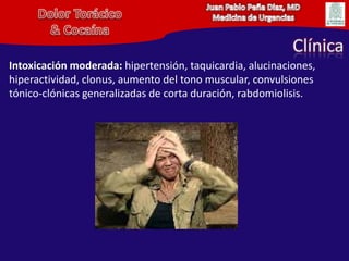 Juan Pablo Peña Diaz, MDMedicina de UrgenciasDolor Torácico& CocaínaClínicaIntoxicación moderada: hipertensión, taquicardia, alucinaciones, hiperactividad, clonus, aumento del tono muscular, convulsiones tónico-clónicas generalizadas de corta duración, rabdomiolisis. 
