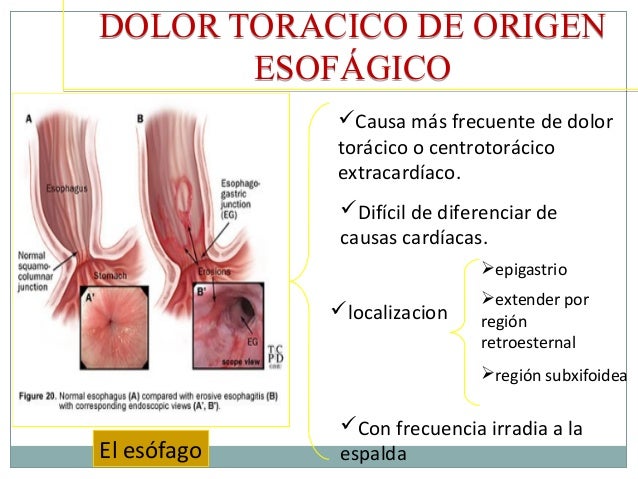 La gimnasia a sheynom la osteocondrosis