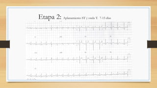 Etapa 2: Aplanamiento ST y onda T. 7-15 días
 