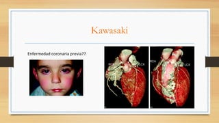 Kawasaki
Enfermedad	coronaria	previa??	
 