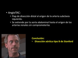 • AngioTAC:
• Flap de disección distal al origen de la arteria subclavia
izquierda.
• Se extiende por la aorta abdominal hasta el origen de las
arterias renales sin comprometerlas
Conclusión:
• Disección aórtica tipo B de Stanford
 