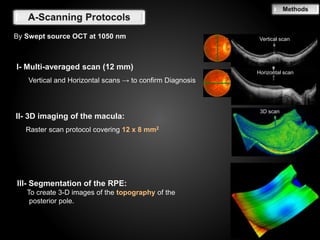 Macular Raster Dome shaped macula in High myopia - Swept-source Optical coherence ...