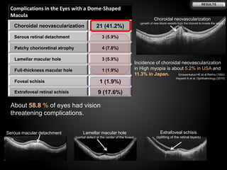 Dome shaped macula in High myopia - Swept-source Optical coherence ...