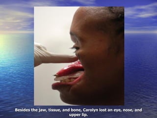 Besides the jaw, tissue, and bone, Carolyn lost an eye, nose, and upper lip. 