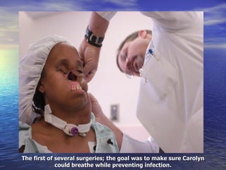 The first of several surgeries; the goal was to make sure Carolyn could breathe while preventing infection. 