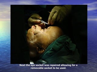 Next the eye socket was repaired allowing for a removable socket to be used. 