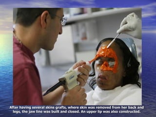 After having several skins grafts, where skin was removed from her back and legs, the jaw line was built and closed. An upper lip was also constructed. 