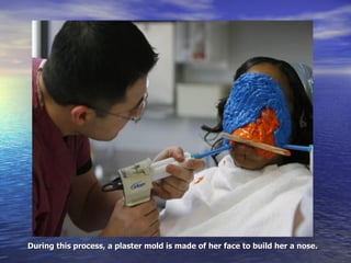 During this process, a plaster mold is made of her face to build her a nose. 