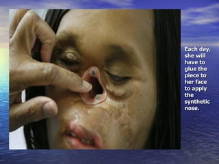 Each day, she will have to glue the piece to her face to apply the synthetic nose. 