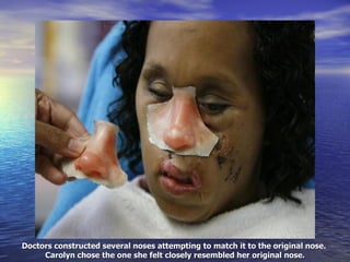 Doctors constructed several noses attempting to match it to the original nose.  Carolyn chose the one she felt closely resembled her original nose. 