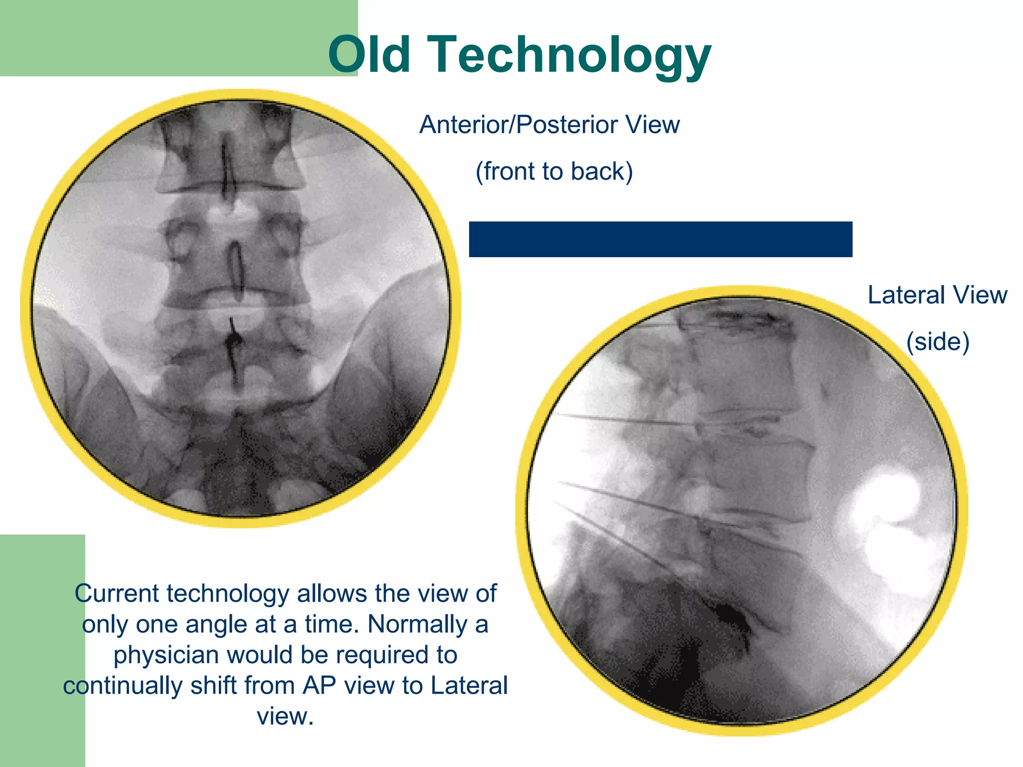 Old Technology Anterior/Posterior View (front to back) Lateral View (side) Current technology allows the view of only one angle at a time. Normally a physician would be required to continually shift from AP view to Lateral view. 
