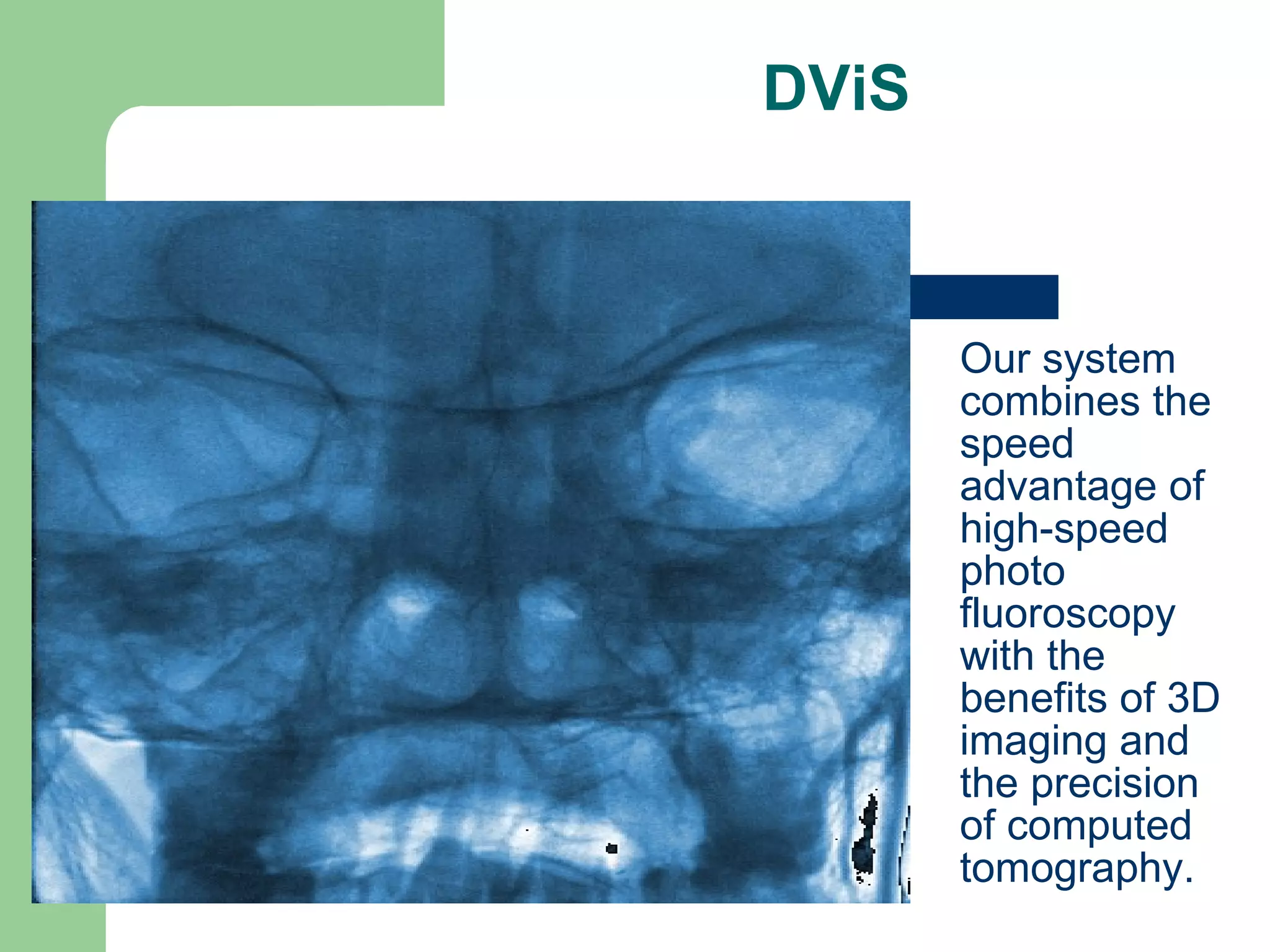 DViS Our system combines the speed advantage of high-speed photo fluoroscopy with the benefits of 3D imaging and the precision of computed tomography. 