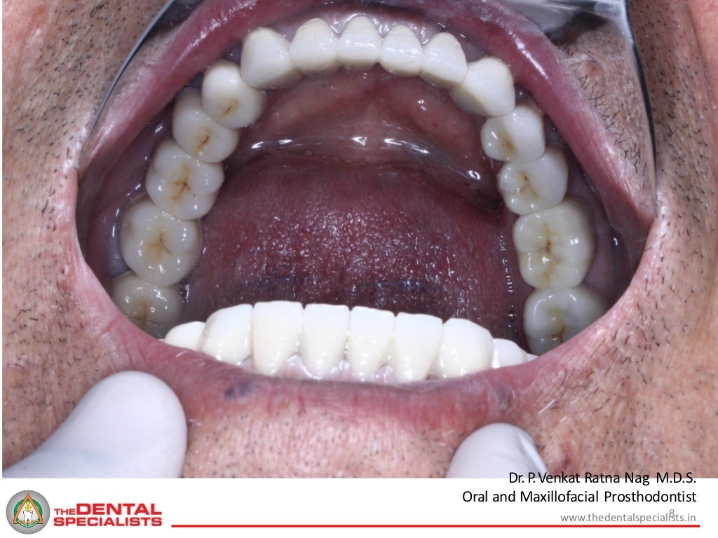 Case study maxilla picture