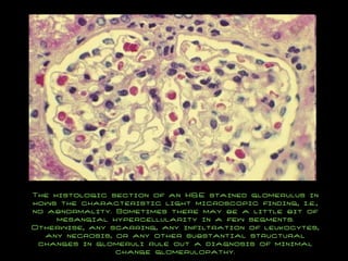 The histologic section of an H&E stained glomerulus in hows the characteristic light microscopic finding, i.e., no abnormality. Sometimes there may be a little bit of mesangial hypercellularity in a few segments. Otherwise, any scarring, any infiltration of leukocytes, any necrosis, or any other substantial structural changes in glomeruli rule out a diagnosis of minimal change glomerulopathy. 