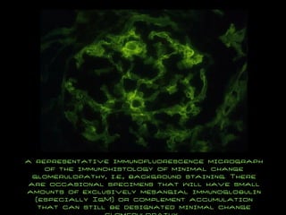 a representative immunofluorescence micrograph of the immunohistology of minimal change glomerulopathy, i.e., background staining. There are occasional specimens that will have small amounts of exclusively mesangial immunoglobulin (especially IgM) or complement accumulation that can still be designated minimal change glomerulopathy.  