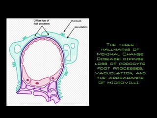 The three hallmarks of Minimal Change Disease: diffuse loss of podocyte foot processes, vacuolation, and the appearance of microvilli.  
