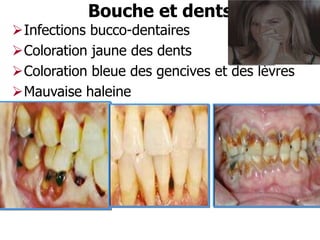 Bouche et dents

Infections bucco-dentaires
Coloration jaune des dents
Coloration bleue des gencives et des lèvres
Mauvaise haleine

 