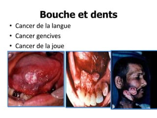 Bouche et dents
• Cancer de la langue
• Cancer gencives
• Cancer de la joue

 