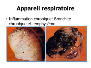 Appareil respiratoire
• Inflammation chronique: Bronchite
chronique et emphysème

 