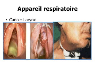 Appareil respiratoire
• Cancer Larynx

 