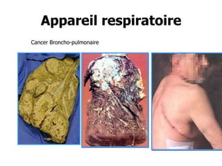 Appareil respiratoire
Cancer Broncho-pulmonaire

 