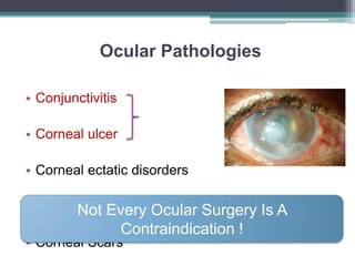 Ocular Pathologies
• Conjunctivitis
• Corneal ulcer
• Corneal ectatic disorders
• Previous corneal surgery
• Corneal Scars
Not Every Ocular Surgery Is A
Contraindication !
 