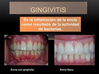 Es la inflamación de la encía
como resultado de la actividad
de bacterias.
GINGIVITIS
Encía con gingivitis Encía Sana
 