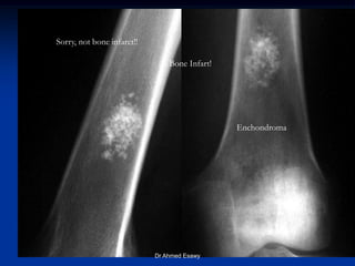 Bone Infarctr “Don’t touch” lesions new version Dr Ahmed Esawy | PDF