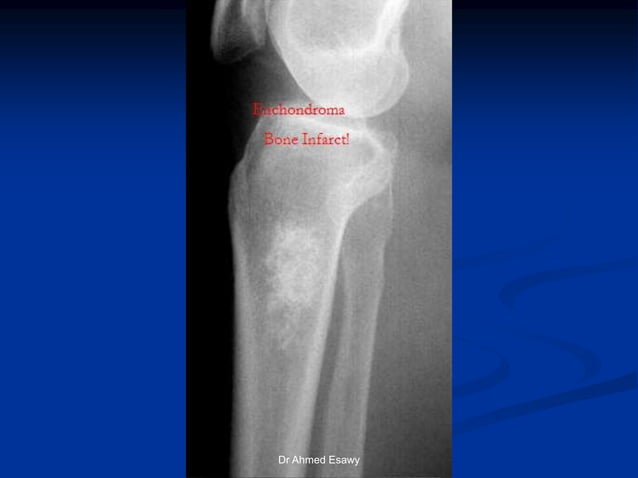 Touch Tibia “Don’t touch” lesions new version Dr Ahmed Esawy | PDF