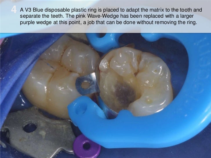 Do on First Molar with Cusp Missing by Jonathan Swarbrigg, BDS