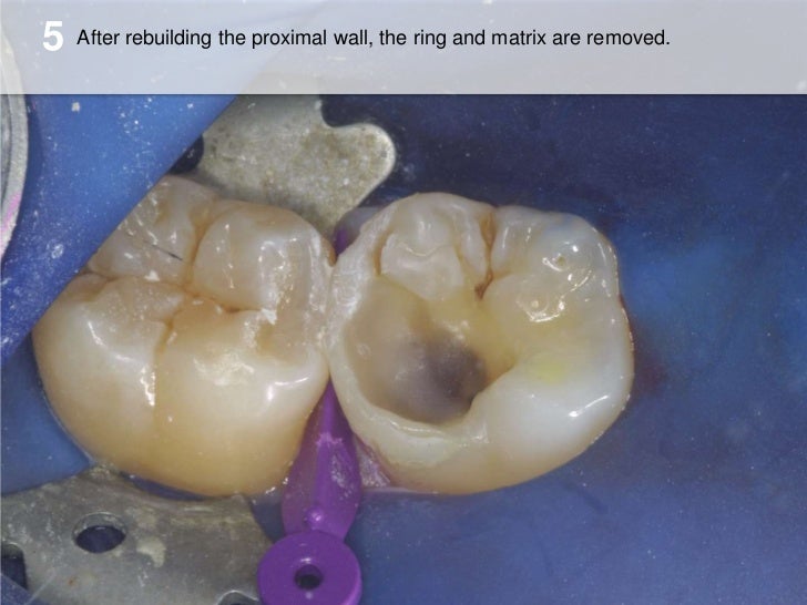 Do on First Molar with Cusp Missing by Jonathan Swarbrigg, BDS