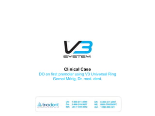 Clinical Case DO on first premolar using V3 Universal Ring GernotMörig, Dr. med. dent. 
