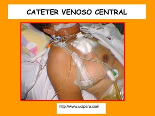 CATETER VENOSO CENTRAL




       http://www.uciperu.com
 