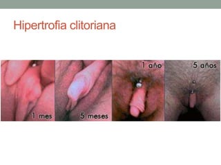 Hipertrofia clitoriana
 