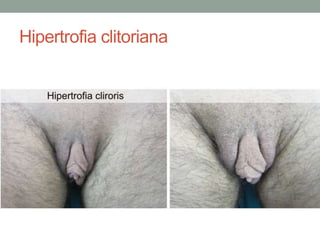 Hipertrofia clitoriana
 