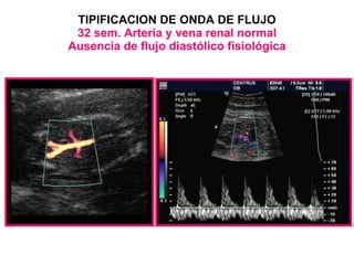 TIPIFICACION DE ONDA DE FLUJO 32 sem. Arteria y vena renal normal Ausencia de flujo diastólico fisiológica 