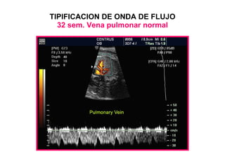 TIPIFICACION DE ONDA DE FLUJO 32 sem. Vena pulmonar normal 